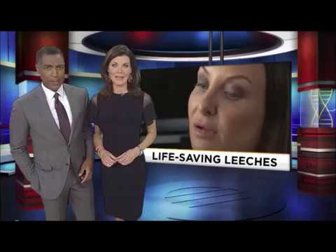 MY INTERVIEW WITH WPLG CHANNEL 10 MIAMI I THIS IS MY STORY OF A BOTCHED RHINOPLASTY